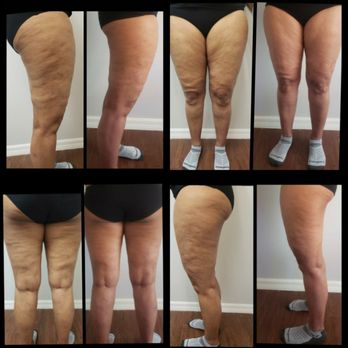 Cavi Spa - Cellulite Reduction Results - Medical Spas Near Me - Tampa, Florida Cavi Spa - Cellulite Reduction Results - Medical Spas Near Me - Tampa, Florida