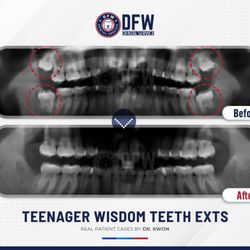 DFW Dental Service Invisalign Family Cosmetic Implants - DFW Dental Service - Family, Cosmetic, Implants Dentist of Irving, Texas | 209 S O Connor Rd, Irving, Texas 75060 | Call: (972) 251-1701