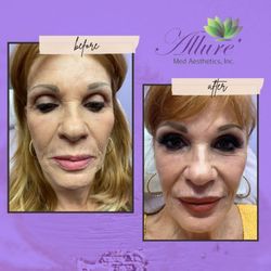 Allure Med Aesthetics - No surgery, no downtime. Only laser and injectables