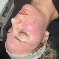 SkinStudioMN - After Micro-Needling, redness goes down in a 24 hour period!
