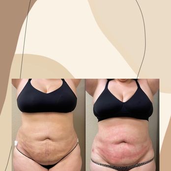 B Sculpted - Softening her fibrosis after getting Lipo with the Venus Legacy - Body Contouring Near Me - San Ramon, California
