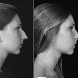 Park Cities Cosmetic Surgery - Dr. Michael Lee Double Board Certified Plastic Surgery and ENT. Find out more about rhinoplasty at parkcitiescosmeticsurgery.com