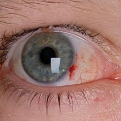 Franz Michel, MD - Ventura County Lasik