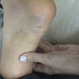 This is a picture two days after he "stepped on a thorn." This is a picture two days after he "stepped on a thorn."