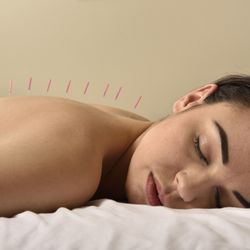 Daphne Acupuncture Center - Acupuncture treatment McKinney tx