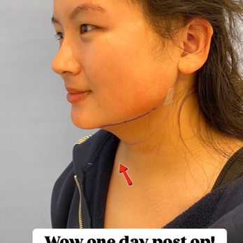 Catherine Begovic, MD - 1 day after - Cosmetic Surgeons Near Me - Beverly Hills, California