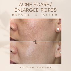 Alcler Medspa - Secret-RF and JuveLook acne scar/enlarged pore treatment.