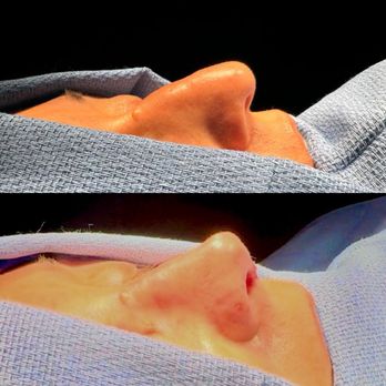 Moustafa Mourad, MD - Pre and Post-op nose on table - Plastic Surgeons Near Me - New York, New York Moustafa Mourad, MD - Pre and Post-op nose on table - Plastic Surgeons Near Me - New York, New York