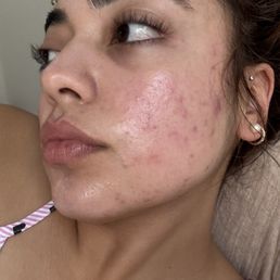 1.5 months after second micro needling here. Worse than my teenage acne.