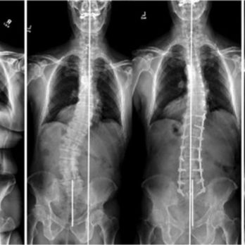 Corey T Walker, MD - Spine Surgeons Near Me - Los Angeles, California Corey T Walker, MD - Spine Surgeons Near Me - Los Angeles, California