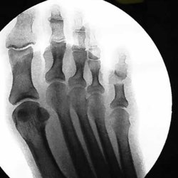 Idaho Foot & Ankle Associates - The xray taken the day of surgery at the surgery center