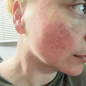 San Diego Cryotherapy - A rash from whatever they did to my face - Cryotherapy Near Me - San Diego, California San Diego Cryotherapy - A rash from whatever they did to my face - Cryotherapy Near Me - San Diego, California