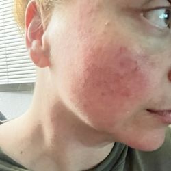 San Diego Cryotherapy - A rash from whatever they did to my face