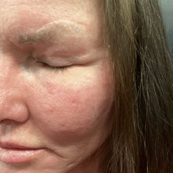 Blackledge Face Center - Deep scar above brow. Just far enough above brow line, microblading isn't an option. I had brows microbladed to help with the shape. - Cosmetic Surgeons Near Me - Jackson, Mississippi