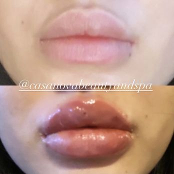 Casanovabeautyandspa - Treatable areas:
-Lips, Jawlines, Forehead lines, Chin, Cheekbones, Crows Feet Wrinkles, Smile Lines and more... - Teeth Whitening Near Me - Houston, Texas Casanovabeautyandspa - Treatable areas:
-Lips, Jawlines, Forehead lines, Chin, Cheekbones, Crows Feet Wrinkles, Smile Lines and more... - Teeth Whitening Near Me - Houston, Texas