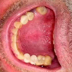 Pacific Dental Centre - 3 missing teeth. Dr. Jack Gardner.