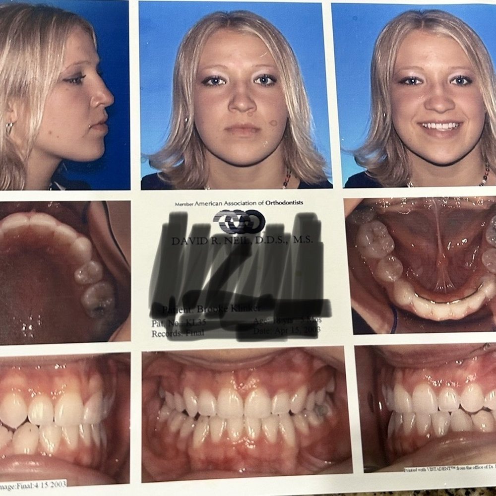 Precision Dental - My teeth when I got my braces off 20 years ago. - General Dentistry Near Me - Gilbert, Arizona Precision Dental - My teeth when I got my braces off 20 years ago. - General Dentistry Near Me - Gilbert, Arizona