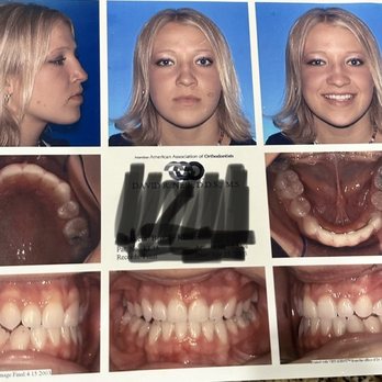 Precision Dental - My teeth when I got my braces off 20 years ago. - The image features a collage of dental photographs, including facial profile and frontal views of a young woman, as well as intraoral images of her upper and lower teeth from different perspectives. The photos are taken against a blue background, with some images showing the teeth from above, below, and side angles, likely for orthodontic or dental assessment purposes. There is also a central section with a partially obscured dental record card. - General Dentistry Near Me - Gilbert, Arizona