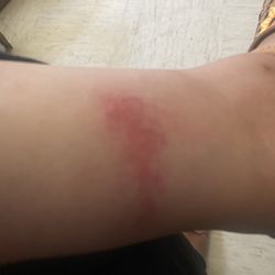 Coalinga Motel - A rash that is getting larger and darker