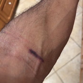 Liberty Pacific Advanced Imaging - how NOT to draw blood (esp when I have such great veins) - Radiologists Near Me - Tarzana, California Liberty Pacific Advanced Imaging - how NOT to draw blood (esp when I have such great veins) - Radiologists Near Me - Tarzana, California