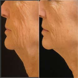 Contour Body Aesthetics - XERF Structural Rejuvenation
Lift * Tighten * Restore Collagen