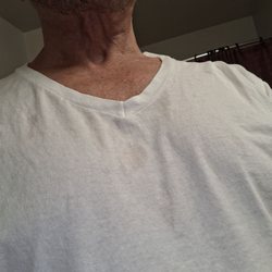 Rodney Schmelzer - 8 months post surgery. I gambled I lost. Nurse lies too- "No drains" for neck surgery.