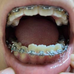 Ghina Morad, DMD - Bad bracket placement causisng unintended tooth movementh