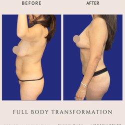 Brett Stompro, MD & Chester Cheng, MD - Liposuction, Tummy Tuck, Breast Augmentation