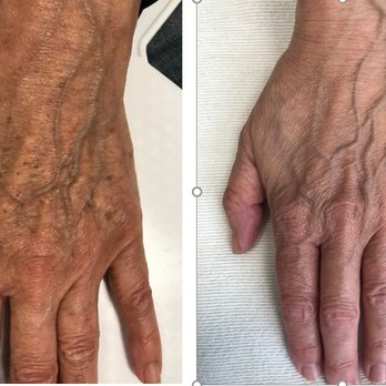 Enhance Skin and Brow - 4 weeks after ONE IPL to treat sun damaged brown pigment on hands - Skin Care Near Me - Bellevue, Washington Enhance Skin and Brow - 4 weeks after ONE IPL to treat sun damaged brown pigment on hands - Skin Care Near Me - Bellevue, Washington