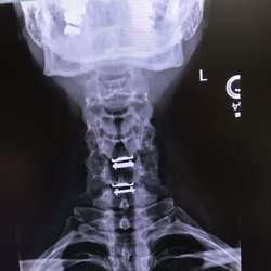 Andrew Fox, MD - Total disc replacement of c 5/6 and 6/7. He was able to avoid a fusion by using the smallest ones they made!