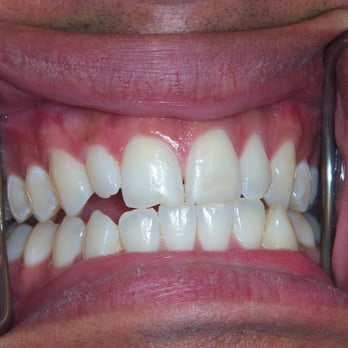 Sirrious Smiles - Four front teeth to be treated. BEFORE - Cosmetic Dentists Near Me - Miami, Florida
