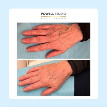 Powell Studio Beauty + Wellness - Revealing this beauty secret...filler isn't just for your face! It's a rejuvenation game-changer for your hands too! - Medical Spas Near Me - Hanover, Massachusetts