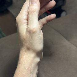 Dignity Health Urgent Care - Pismo Beach - Left wrist, injured, protruding lump