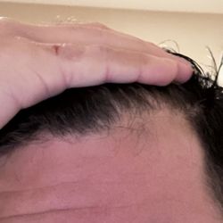Leonard Hair Transplant Associates