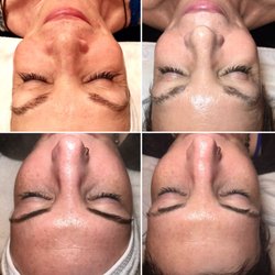 Glow Show Skin Spa - Before & After photos of glow show enzyme facial with microderm and oxygen.