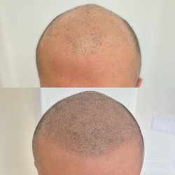 Aesthetic Micropigmentation - Scalp Micropigmentation - Hairline/crown