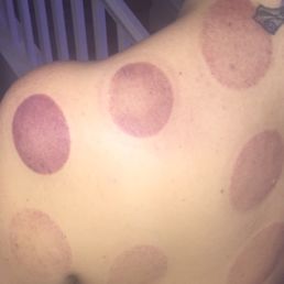Amazing cupping massage! Amazing cupping massage!