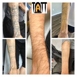 Laser Tattoo Removal by Tatt Cemetery