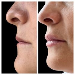 Tranquility Aesthetics and Wellness - Lip Filler