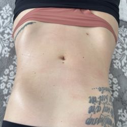 Talbott Plastic Surgery Center - Almost 1 month post op after Lympatic Massage