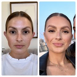 Toft Facial Plastic Surgery - 1 day before surgery vs. 3 WEEKS post op