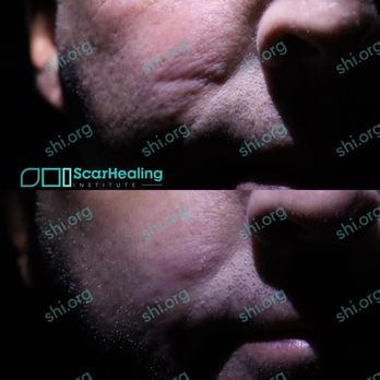 Scar Healing Institute - Dermatologists Near Me - Beverly Hills, California Scar Healing Institute - Dermatologists Near Me - Beverly Hills, California