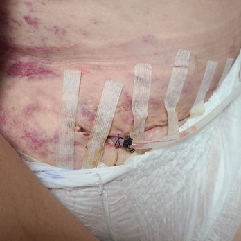 Dr. Manriquez - Horrible work and in pain - Cosmetic Surgeons Near Me