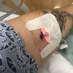 Valley Presbyterian Hospital - The Iv after he stabbed it in and was moving it around trying to find the vein look at the bleeding..