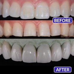 Smile Design Dentistry & Implant Center - Smile Design Dentistry & Implant Center - veneers
