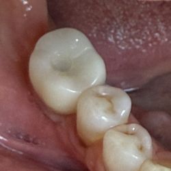 Cascade Oral & Facial Surgery - New crown after debridement, grafting, implant.