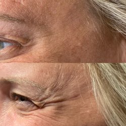 Sparkling Beauty Bar - Botox in the Crow's Feet