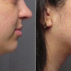 SoCal Aesthetic Surgery - DOUBLE CHIN LIPO BEFORE AND AFTER, LATERAL RIGHT