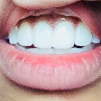 Todd Yerondopoulos, DDS - After - Cosmetic Dentists Near Me - Pleasanton, California Todd Yerondopoulos, DDS - After - Cosmetic Dentists Near Me - Pleasanton, California