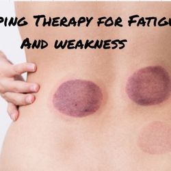 Halina O'Neill Acupuncture - Cupping Therapy for Fatigue